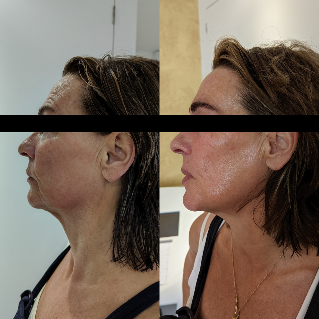 Face Tightening Ipswich